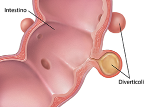 Sezione trasversale di un intestino con sacca di diverticoli nella parete intestinale.