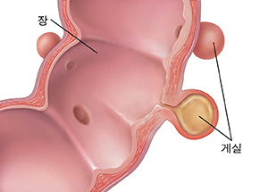 장 벽에 게실 주머니가 보이는 장의 단면도.