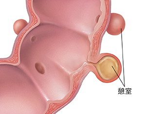 顯示憩室炎的乙狀結腸的剖面圖。