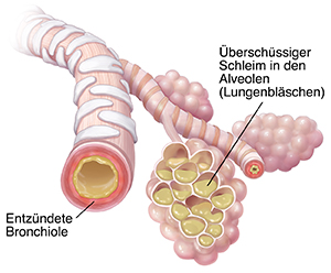 Bronchiole und Lungenbläschen mit Schleimansammlung und Entzündung aufgrund einer Pneumonie.
