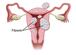 Vista frontale in sezione trasversale dell'utero con tre tipi di fibromi in evidenza.