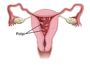 Vista frontale in sezione trasversale del tratto riproduttivo femminile con polipi nell’utero in evidenza.