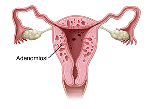 Vista frontale in sezione trasversale dell'utero con adenomiosi.