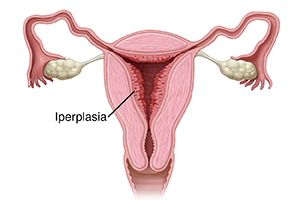 Vista frontale in sezione trasversale del tratto riproduttivo femminile con iperplasia endometriale.