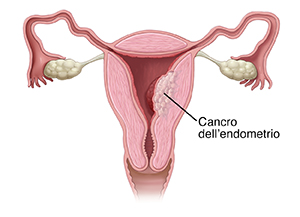 Vista frontale in sezione trasversale del tratto riproduttivo femminile con cancro all’utero.