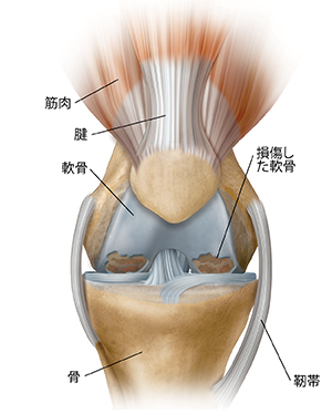 変形性関節症を示す膝の正面図。
