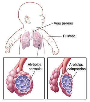 Bebê com a cabeça virada para o lado, mostrando as vias aéreas e os pulmões. Detalhe das vias aéreas com alvéolos normais. Detalhe das vias aéreas com alvéolos colapsados.