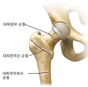 세 가지 유형의 고관절 골절을 보여주는 고관절 전면 모습.